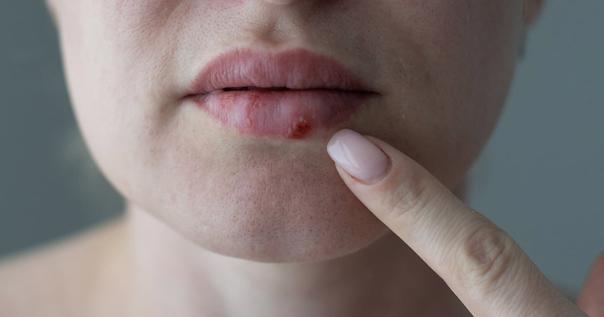 Después de casi treinta años sin novedades, un antiviral oral cambia la pelea contra el herpes que no cede