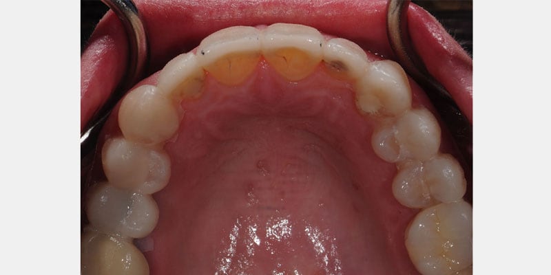 Carillas dentales: la filtración en los bordes puede avanzar hacia el diente